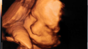 Pain relief for unborn babies  undergoing surgery but none for babies in a late term abortion