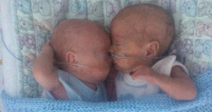 premature twins web