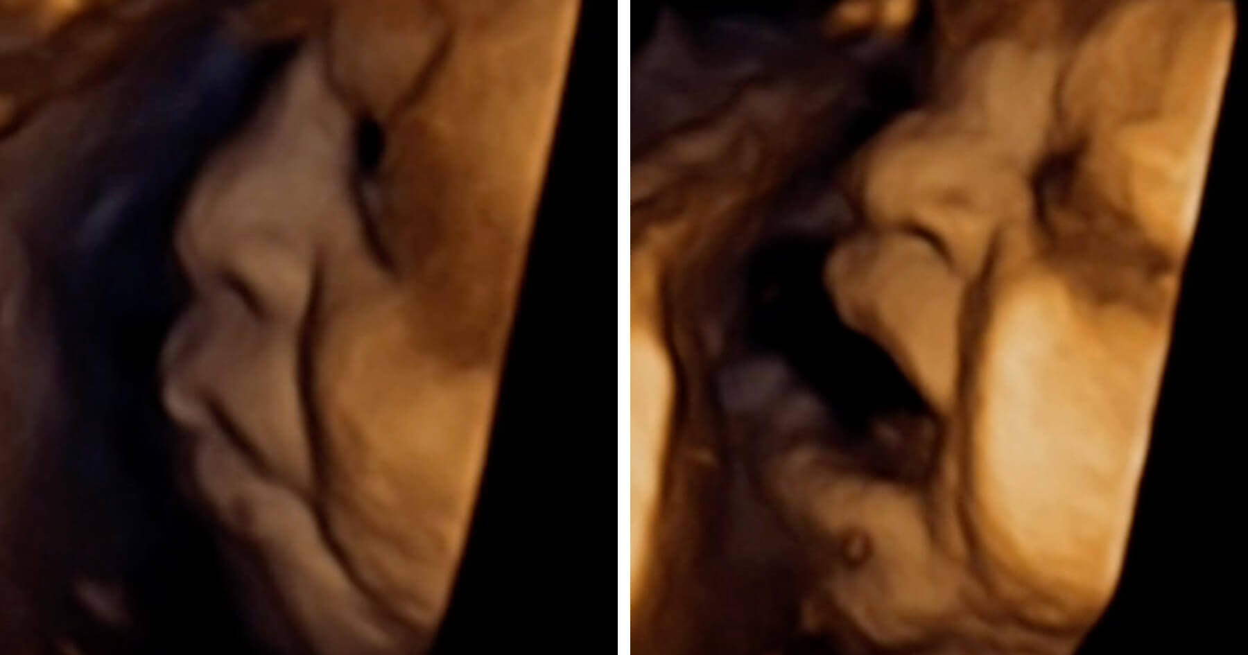 Shocking video shows baby in the womb reacting to being injected