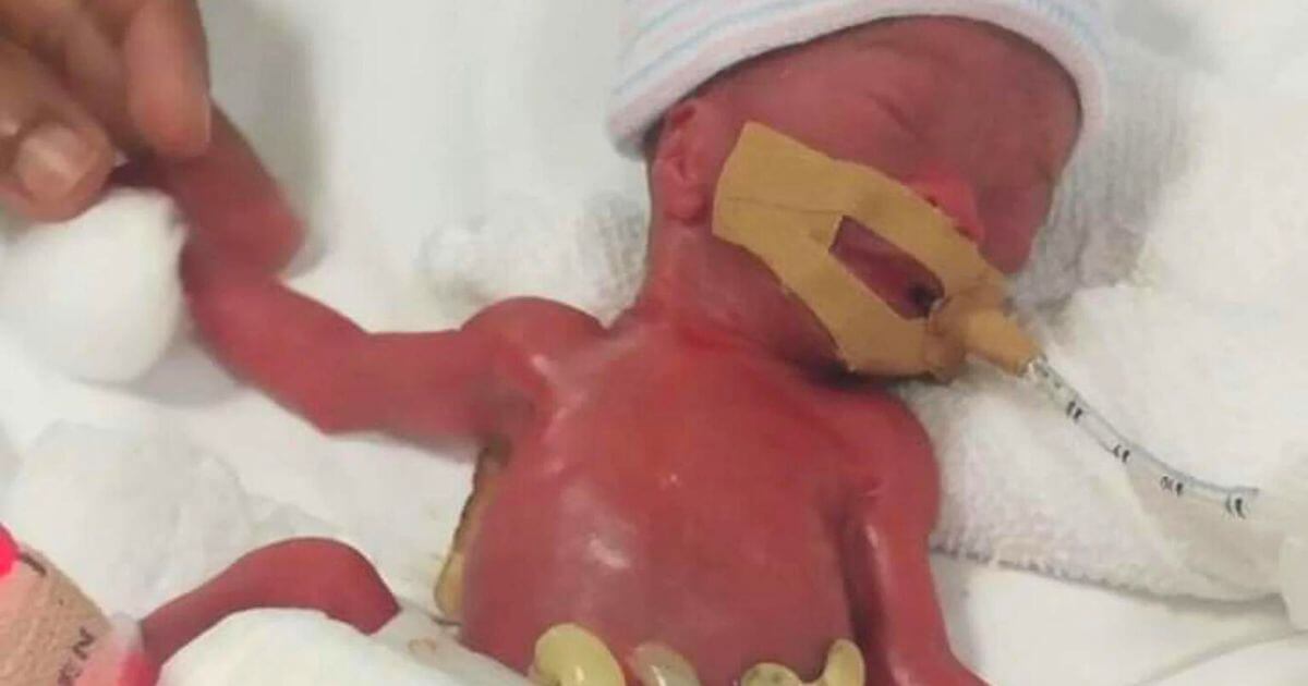 Premature baby weighing just 212g, now healthy and happy two-year old