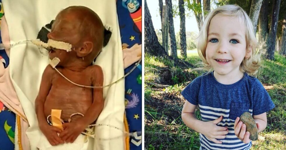 Baby Benson born at 22 weeks is now a healthy 5yearold