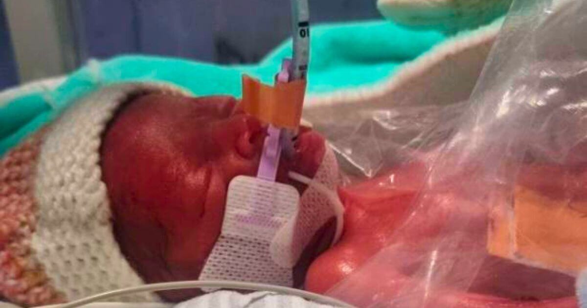 Tiny baby born at 25 weeks weighing as much as a bag of sugar celebrates her first birthday at home