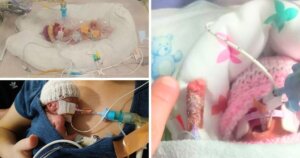Doctors put premature baby into sandwich bag to keep her warm