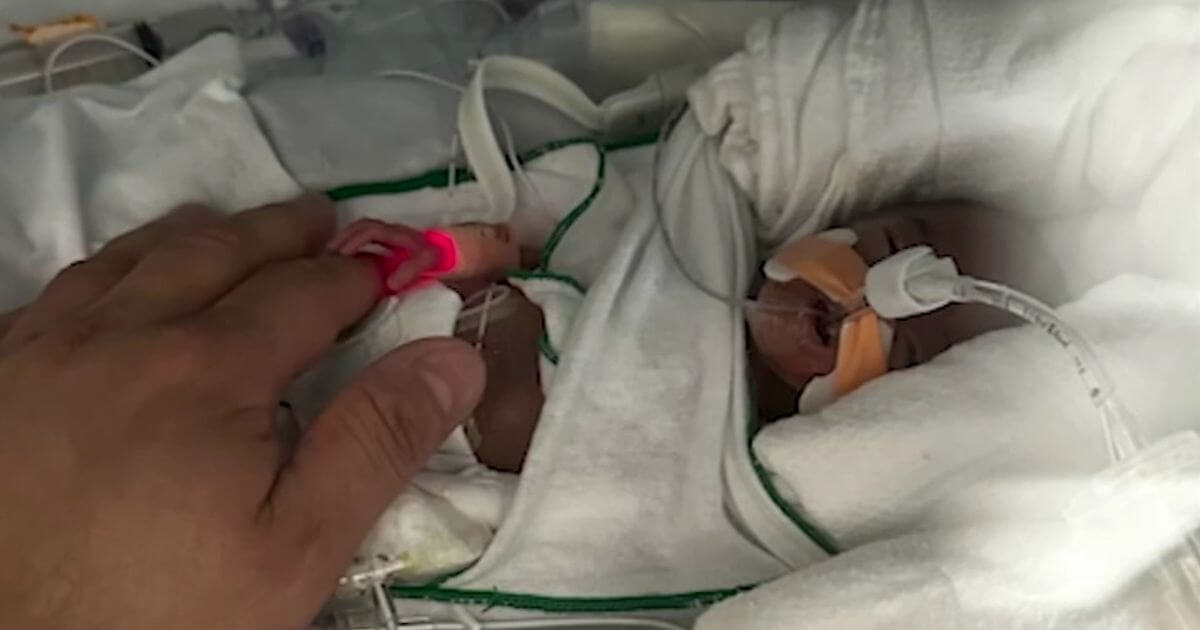 Premature baby goes from less than 1 pound to 12 pounds in seven months