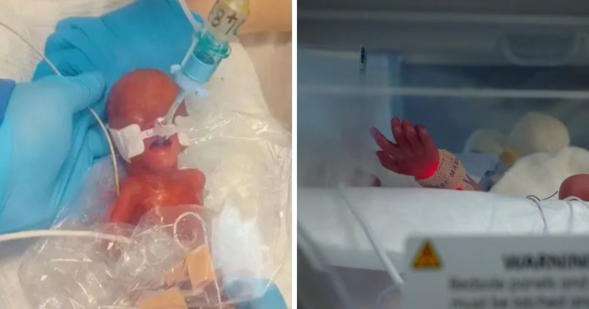 Premature baby girl wrapped in a sandwich bag at birth enjoys first birthday celebrations in hospital
