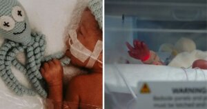 Premature baby born at 25 weeks weighing less than a loaf of bread