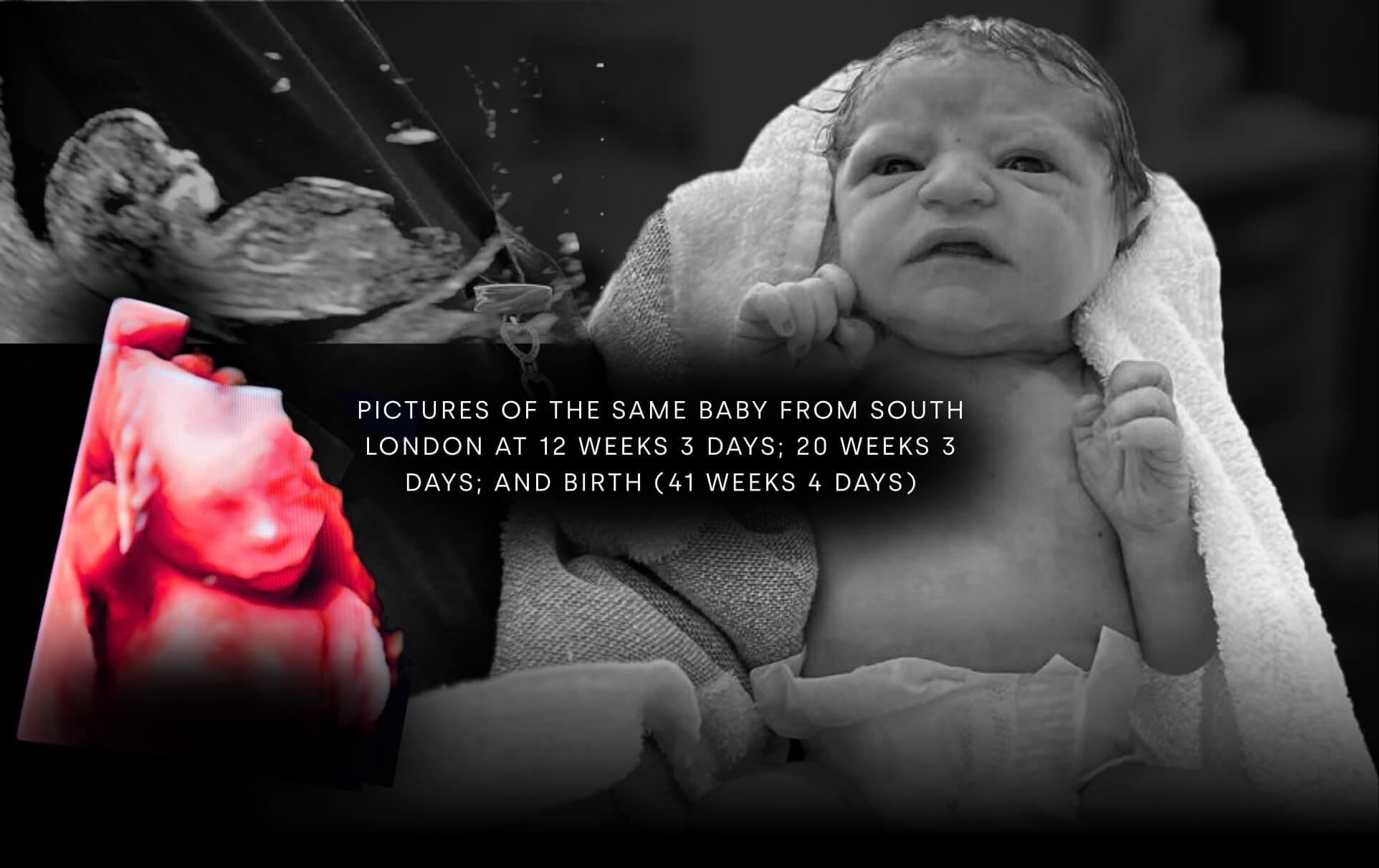 Pictures of the same baby from south London at 12 weeks 3 days; 20 weeks 3 days; and birth (41 weeks 4 days)