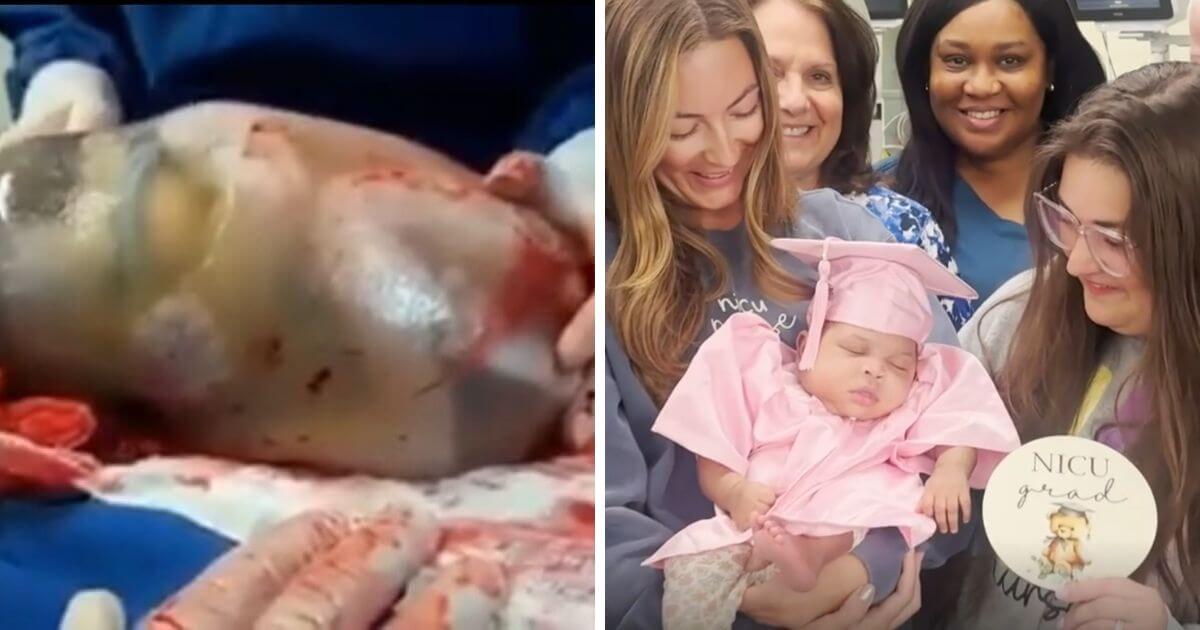“Miracle” premature baby born inside her amniotic sac home after 146 days