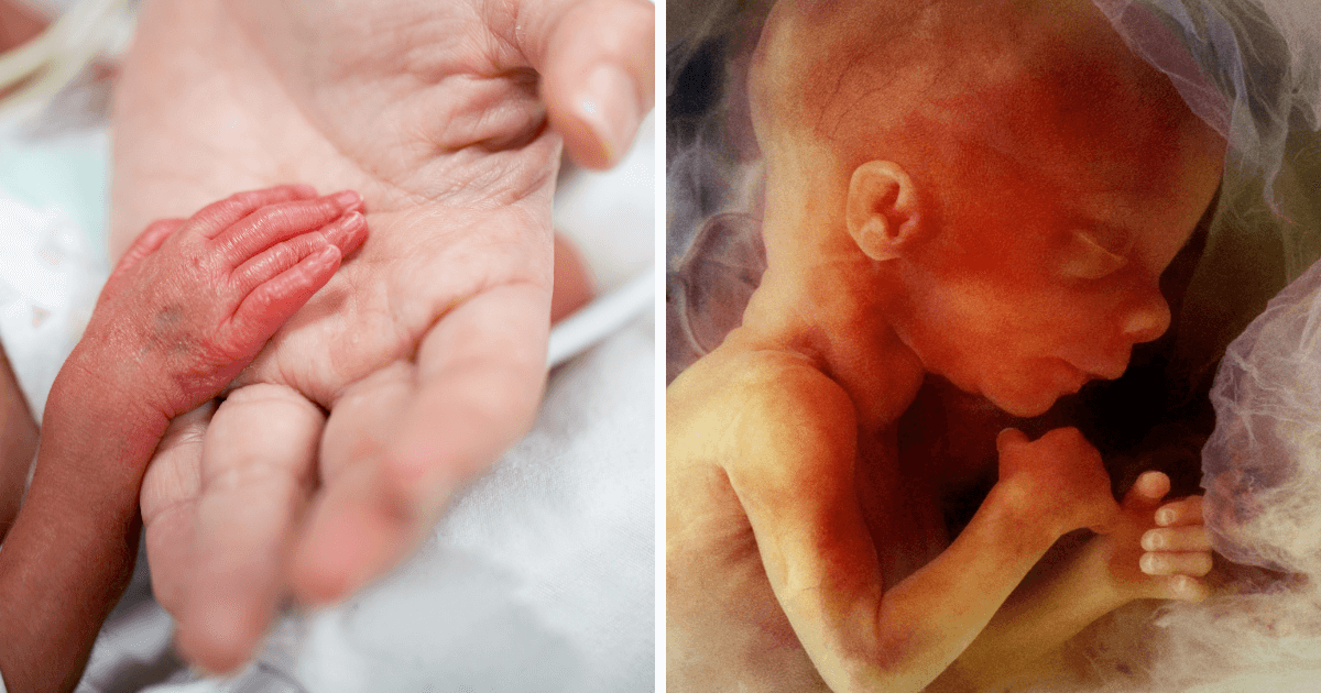 Miracles do happen Premature baby born at 23 weeks and spending 230 days in hospital now home Miracles do happen Premature baby born at 23 weeks and spending 230 days in hospital now home