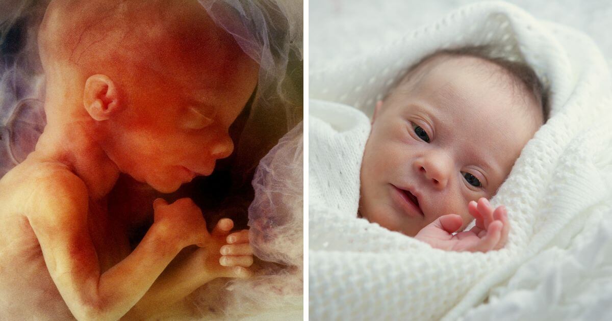 Number of babies with a disability aborted has increased, statistics reveal